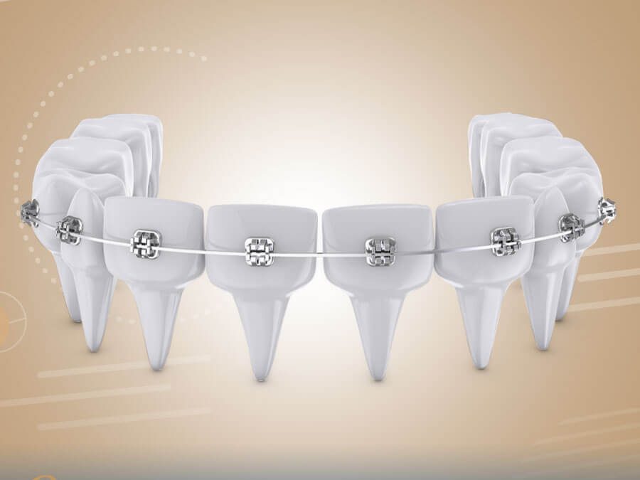 ماهو السن المناسب لتركيب تقويم الاسنان وانواعه؟ | Guarantee dental