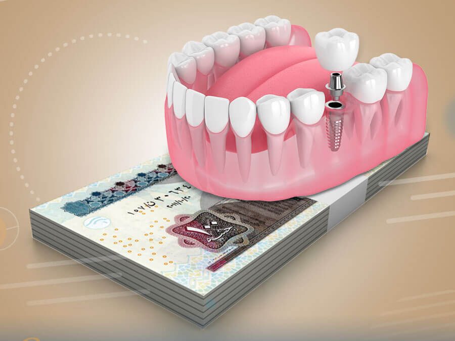 اسعار زراعة الاسنان فى مصر 2021 - Guarantee dental
