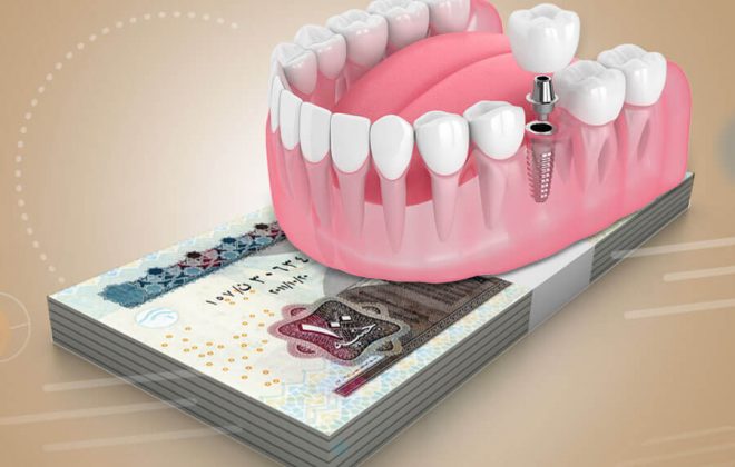 تكلفة زراعة الاسنان فى مصر