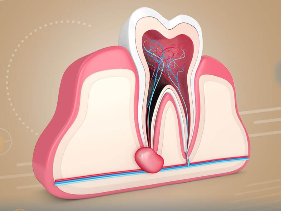 علاج عصب الاسنان