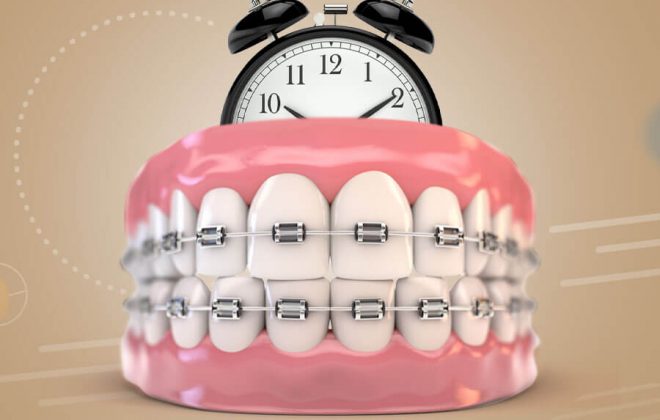 مدة تقويم الاسنان