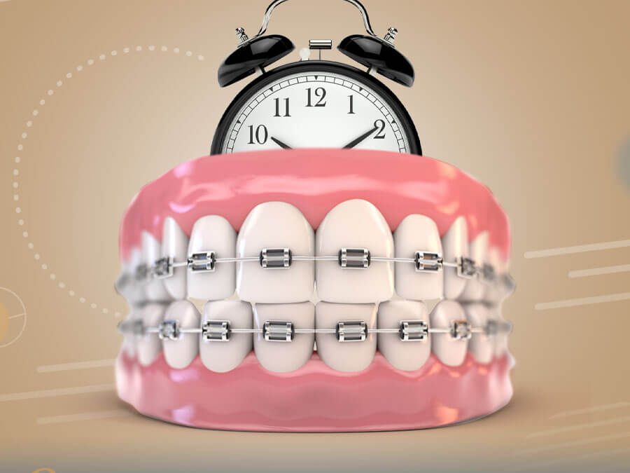 مدة تقويم الاسنان