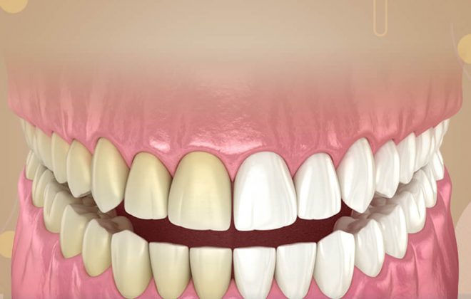 انواع تبييض الاسنان
