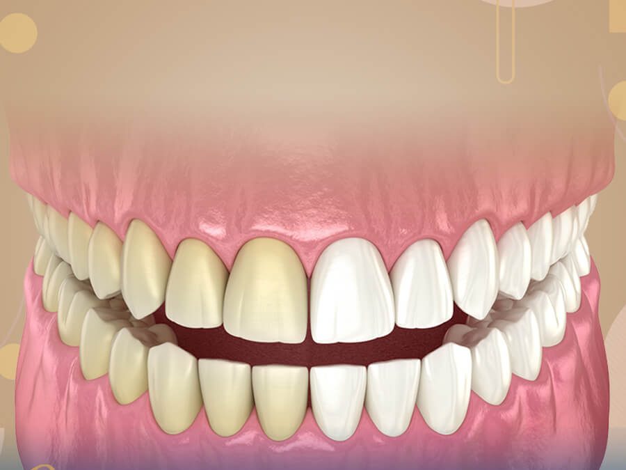 انواع تبييض الاسنان
