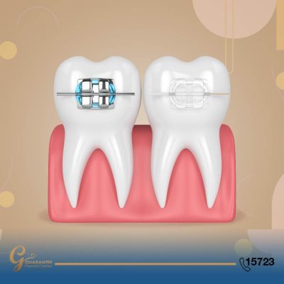 ماهي انواع تقويم الاسنان
