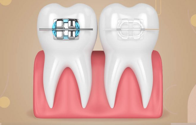 ماهي انواع تقويم الاسنان