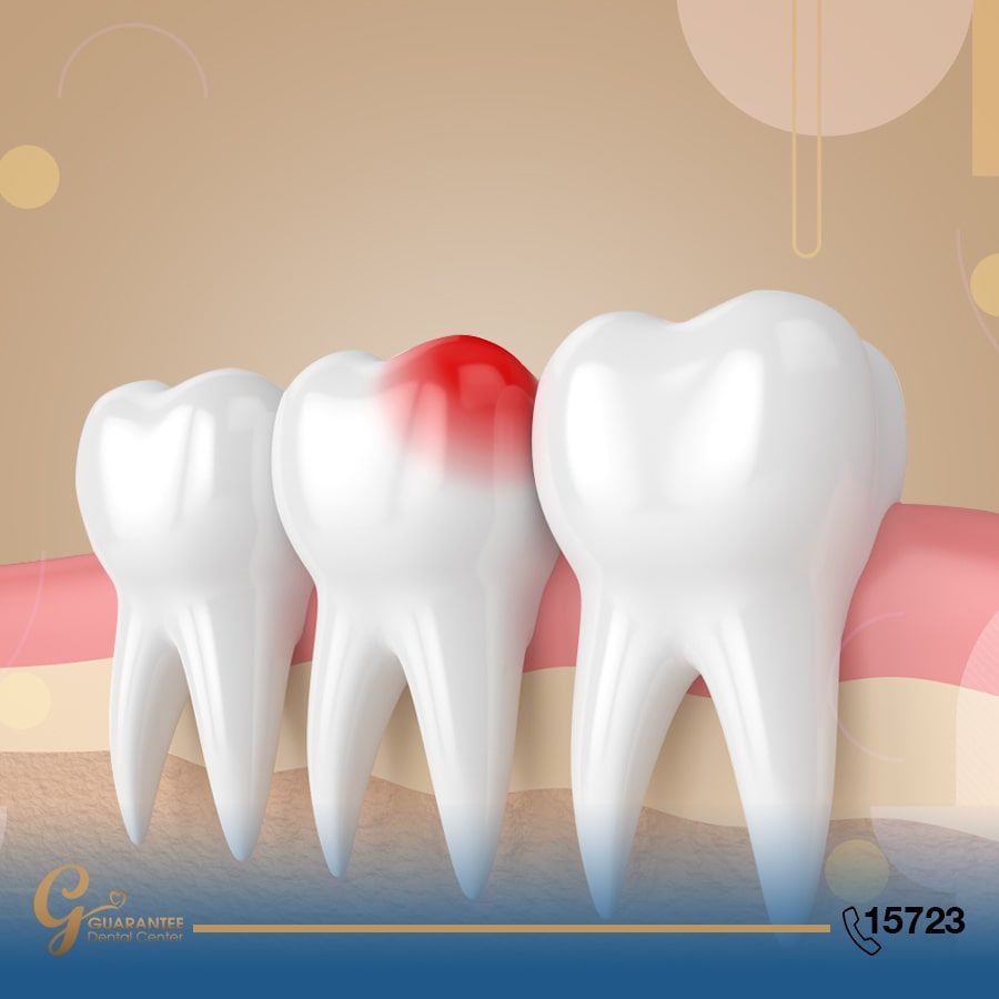 علاج حساسية الاسنان
