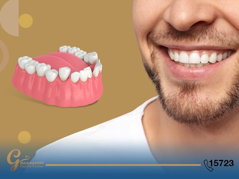 طرق تعديل الاسنان بدون تقويم