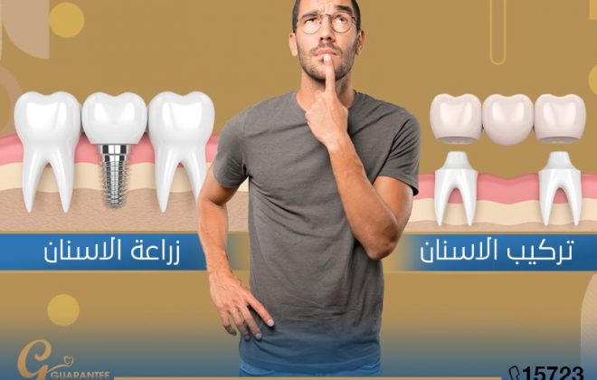 الفرق بين تركيب وزراعة الاسنان